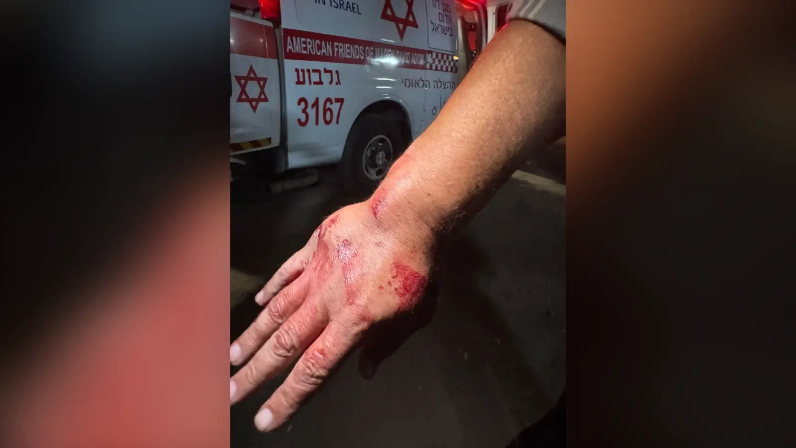 כף היד השבורה של הקורבן כף היד השבורה של הקורבן